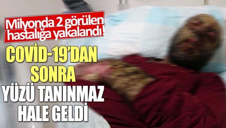 Milyonda 2 kişide görülen hastalık nedeniyle Covid-19 sonrası yüzü tanınmaz hale geldi!