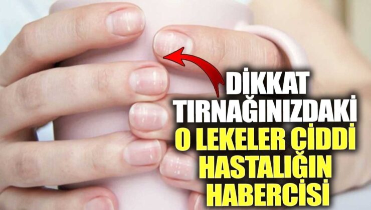 Tırnaklarınızdaki lekeler ciddi bir hastalığa işaret edebilir, dikkat!